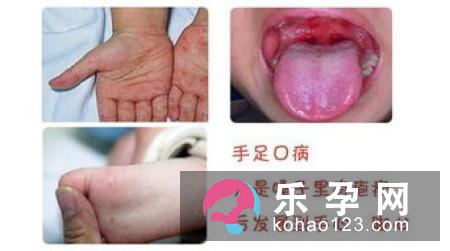 手足口病的潜伏期是几天 症状表现有哪些