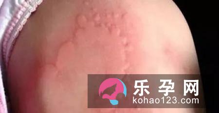 小儿风疹的症状有哪些 会不会发痒