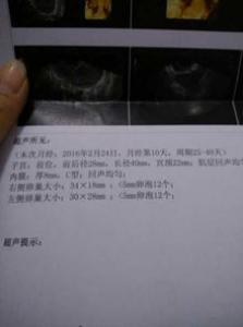 性激素六项可以查出怀孕吗 不正常影响怀孕吗