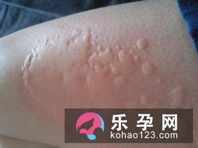 小儿风疹怎样预防 吃什么好