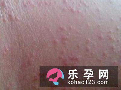 aveeno能治湿疹吗 价格多少钱