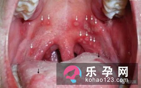 手足口病的潜伏期是几天 症状表现有哪些