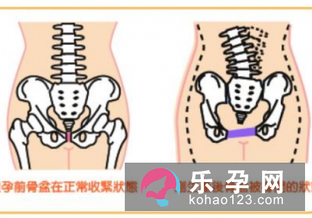 骨盆矫正带哪个牌子好 品牌评价如何