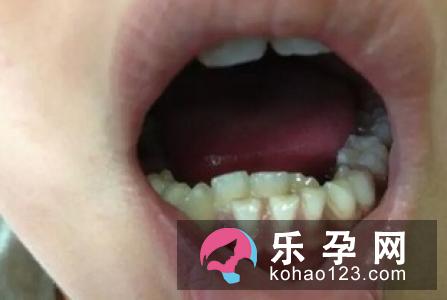 宝宝总共多少颗乳牙 门牙为什么隔很开