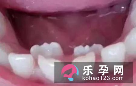 宝宝长牙的顺序 需要多长时间