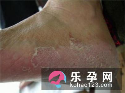 小儿风疹的症状有哪些 会不会发痒