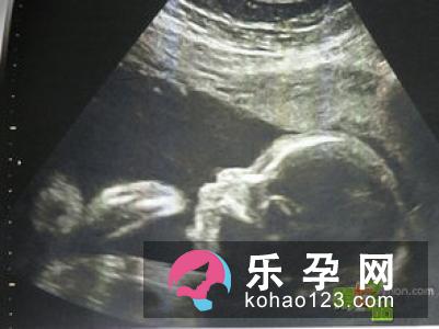 产后头晕怎么回事 生完孩子后头晕怎么办