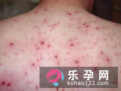 小儿风疹的症状有哪些 会不会发痒