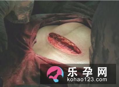 剖腹产真的比自然产安全？