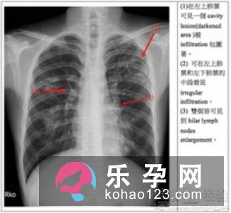 儿童肺结核的症状 能治好吗