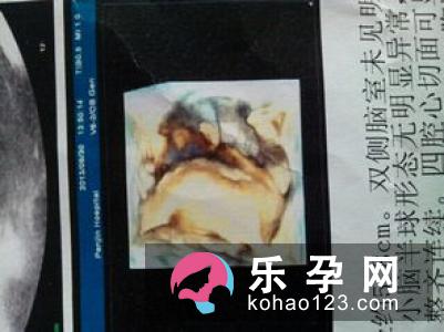 二维彩超能查出胎儿畸形吗 与三维彩超的区别