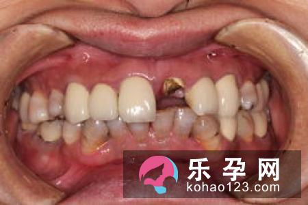 孕妇能做牙齿矫正吗 可以做牙齿根管治疗吗