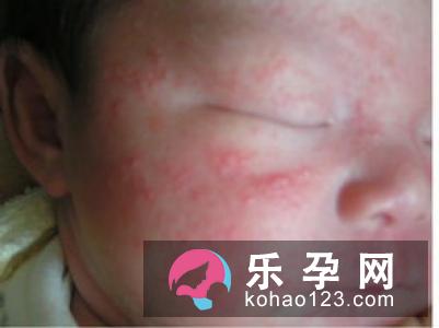 宝宝奶藓会自己好吗 多久消除