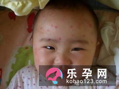 小儿荨麻疹能自愈吗?会发烧吗