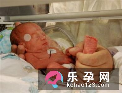 晚剪脐带2分钟有利婴儿健康
