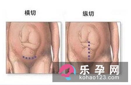 分娩误区：剖腹产热得“烫手”