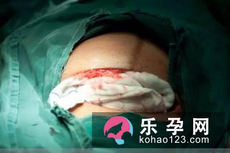 大概有6成孕妇临产时将选择剖腹产手术