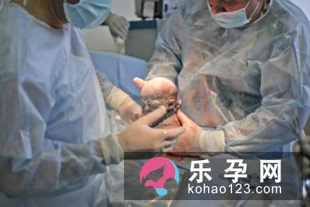 你选择剖腹产以前，应明确知道的