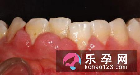 孕妇能做牙齿矫正吗 可以做牙齿根管治疗吗