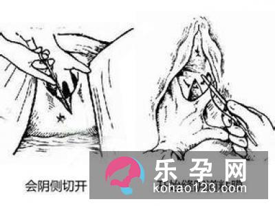 哪种情况的产妇，需要做会阴切开术