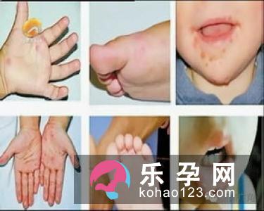 儿童肺结核的症状 能治好吗