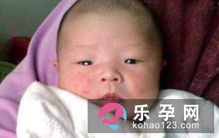 小儿荨麻疹能自愈吗?会发烧吗