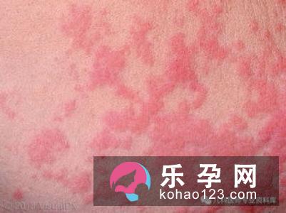 儿童为什么会出现食物过敏 能自行消退吗