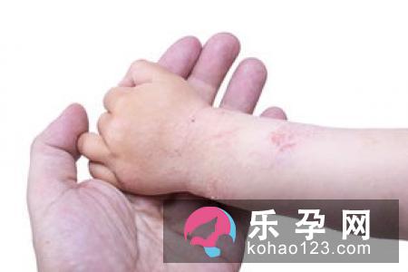 孕妇屁眼痒怎么回事 缺水胎儿会怎么样