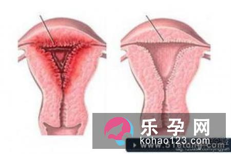 巴氏腺囊肿影响月经吗 如何预防
