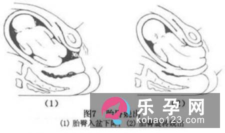 胎儿臀位要如何分娩呢
