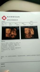 四维彩超可以看出生男生女吗 准确率高吗