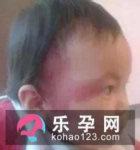 宝宝眼皮上有块红色是怎么回事?血管瘤的三种类型有哪些