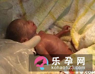 哪些妇女应采取剖腹产