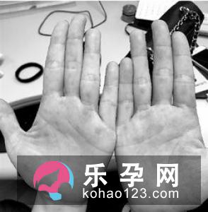 手足口病一定会发烧吗 能吃退烧药吗