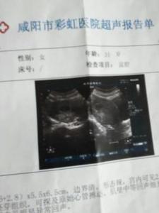 孕囊大小看男孩女孩准吗?偏小怎么办
