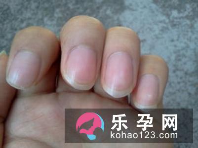 宝宝手指甲有白痕怎么回事 是缺钙吗