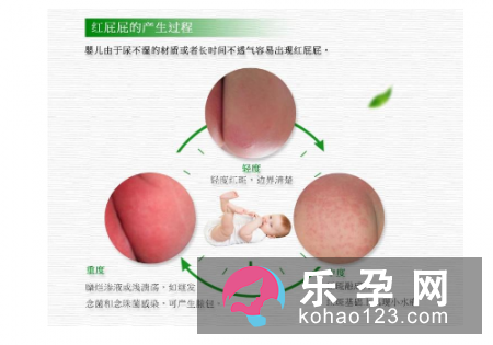 婴儿红屁股是上火吗 原因是什么