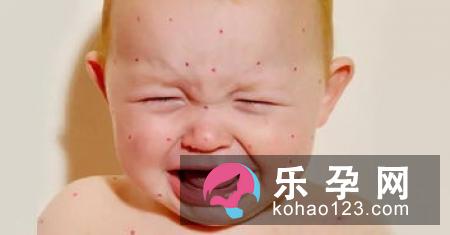 新生儿湿疹可以洗澡吗 和湿度有关系吗