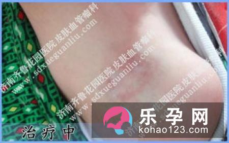 宝宝眼皮上有块红色是怎么回事?血管瘤的三种类型有哪些