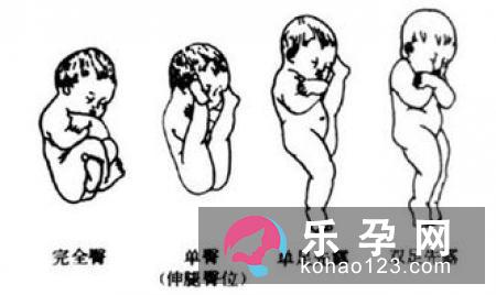 胎儿臀位要如何分娩呢