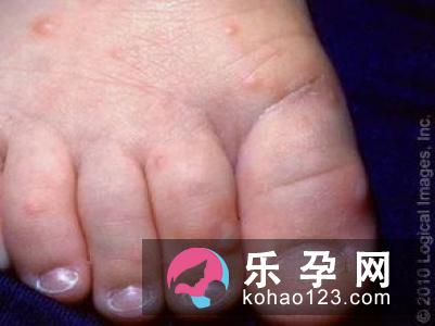 手足口病一定会发烧吗 能吃退烧药吗