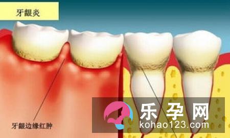 看一看孕晚期容易发生早产的情况