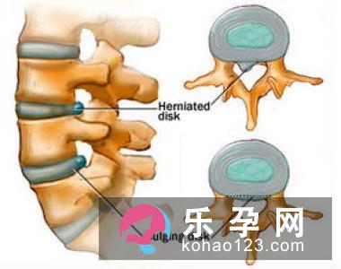 选择剖腹产 尽量在适应症范围