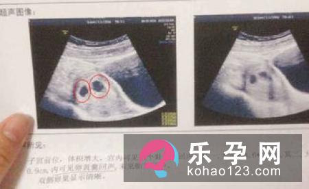 看孕囊形状可以预测生男生女
