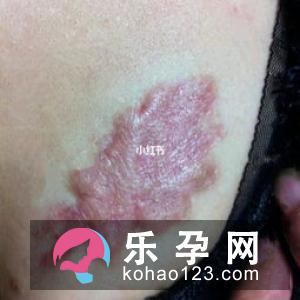 剖腹产疤痕增生怎么办 能去掉吗