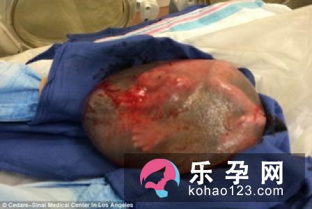 明星大腕都选择剖腹产,这些孕妇就误以为这才是真正健康和流行的方式
