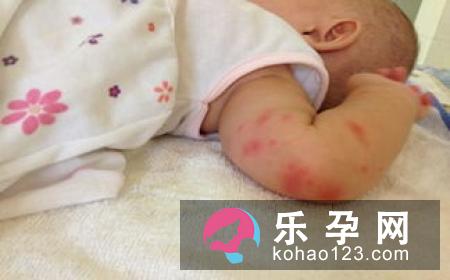 长痱子可以用炉甘石吗 可以用清凉油吗