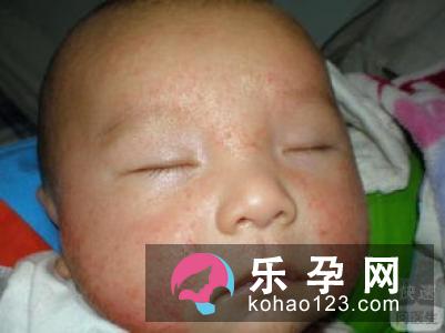 新生儿湿疹可以洗澡吗 和湿度有关系吗