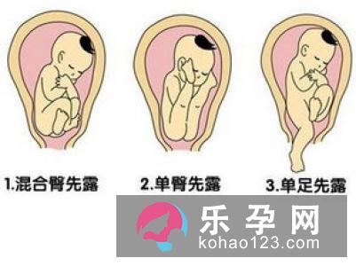 胎儿臀位要如何分娩呢