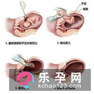 剖宫产逐年上升的原因